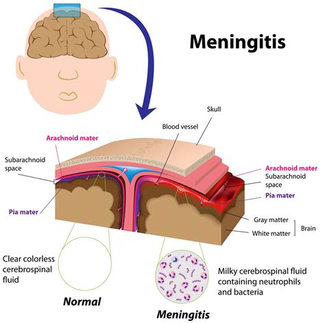 meningitis ursachen und symptome